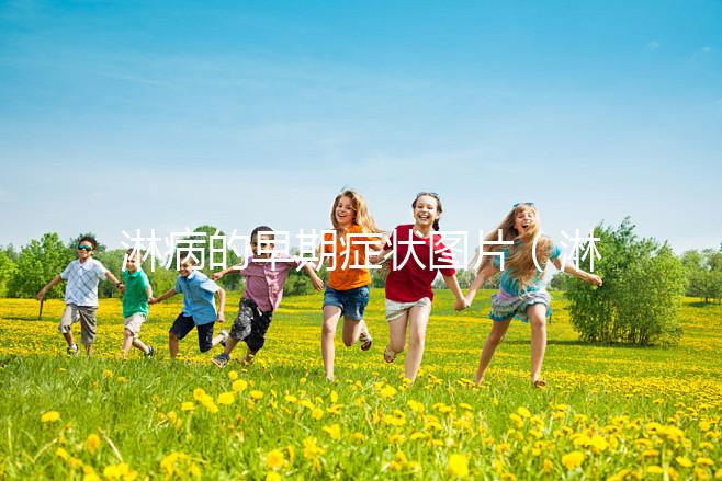 淋病的早期癥狀圖片(淋病有什么癥狀圖片)